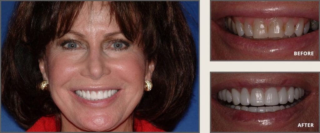 Cosmetic Dentistry before and after in plano, texas