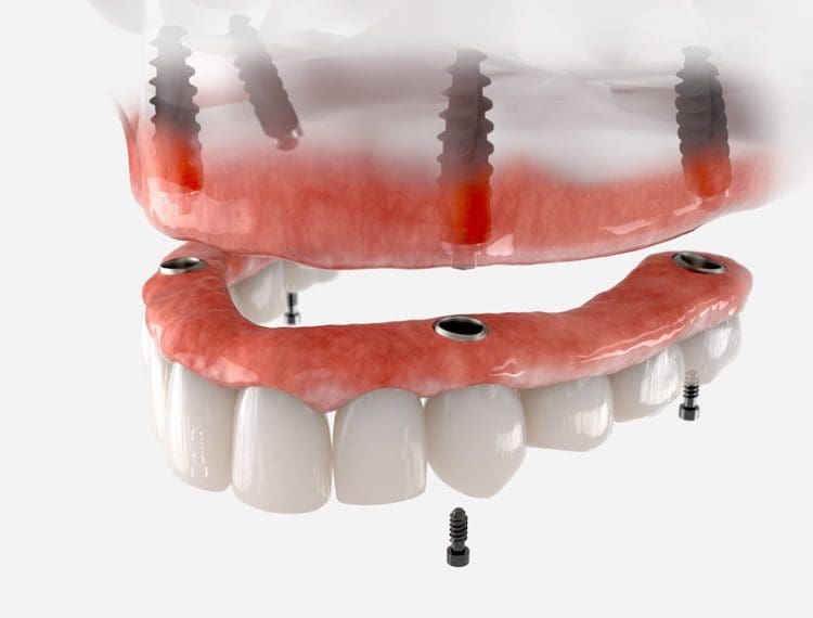 Affordable All-On-Four teeth implants in Plano Texas