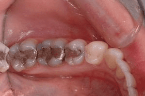 replace metal fillings in plano, texas