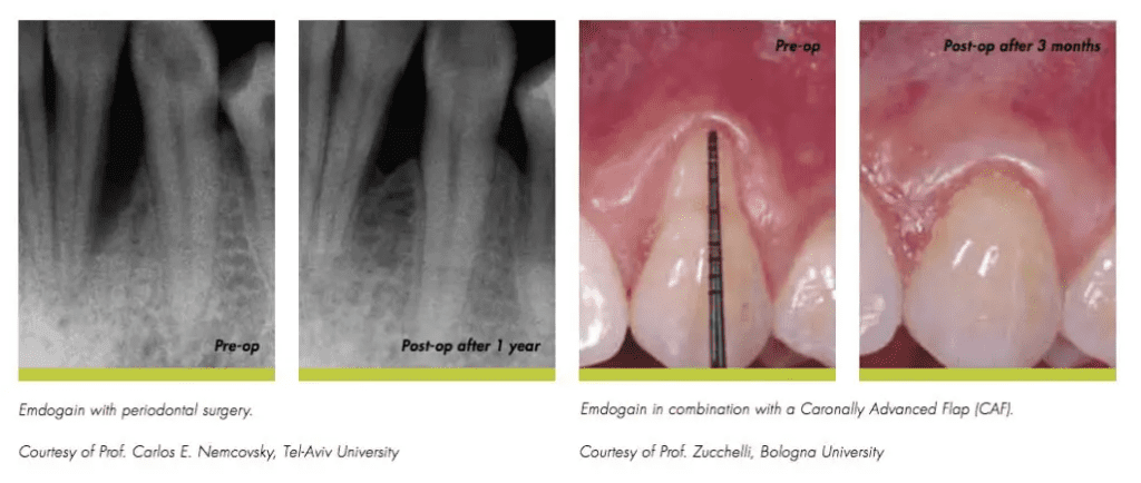 Emdogain Treatment for Gum Recessionin plano, texas