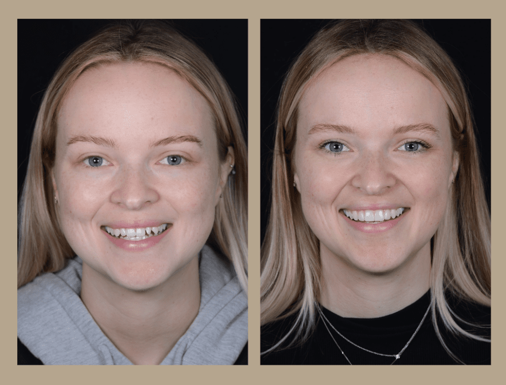 Smile makeover results Plano,  TX cosmetic dentist