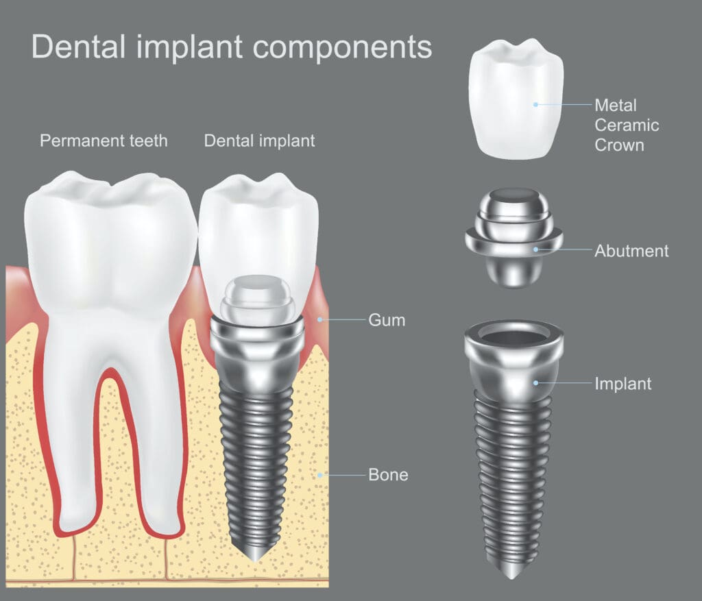 Anatomy of a dental Implant in Plano TX