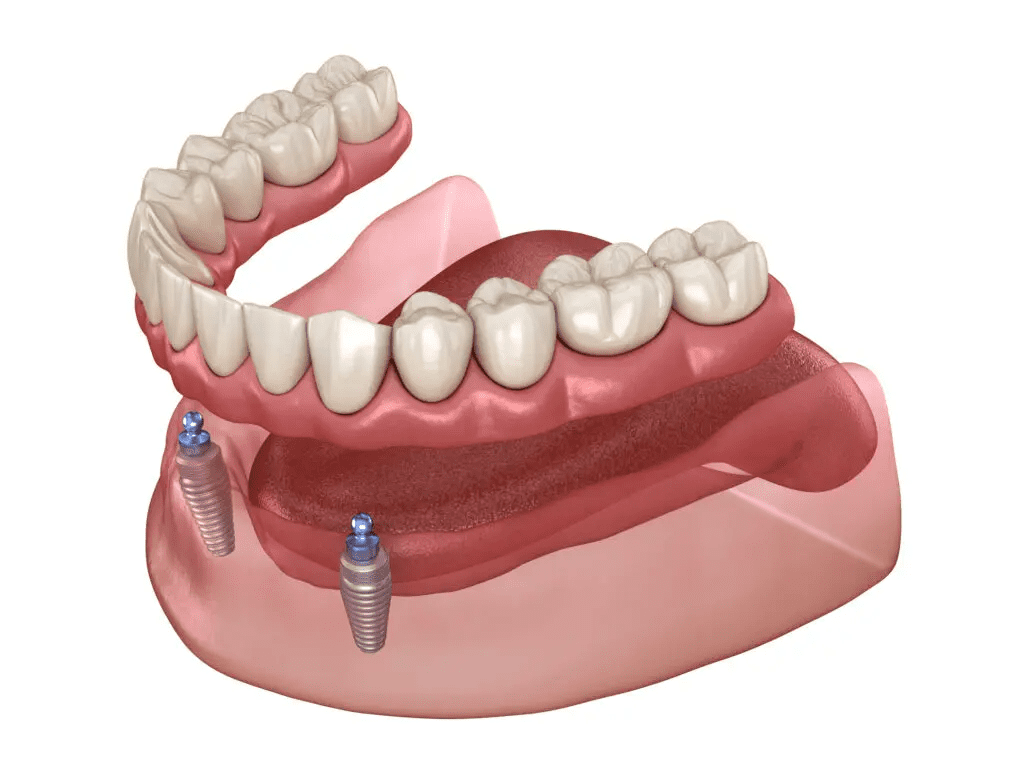 implant supported overdenture in plano tx