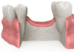 Missing Teeth Bone Loss