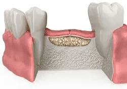 Allograft Bone Grafting for Ridge Augmentation