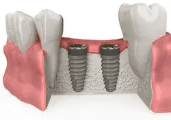 Allograft Bone Grafting for Dental Implants